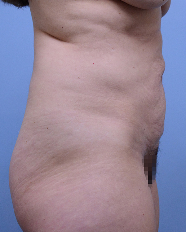 Liposuction Before and After | Dr. Thomas Hubbard