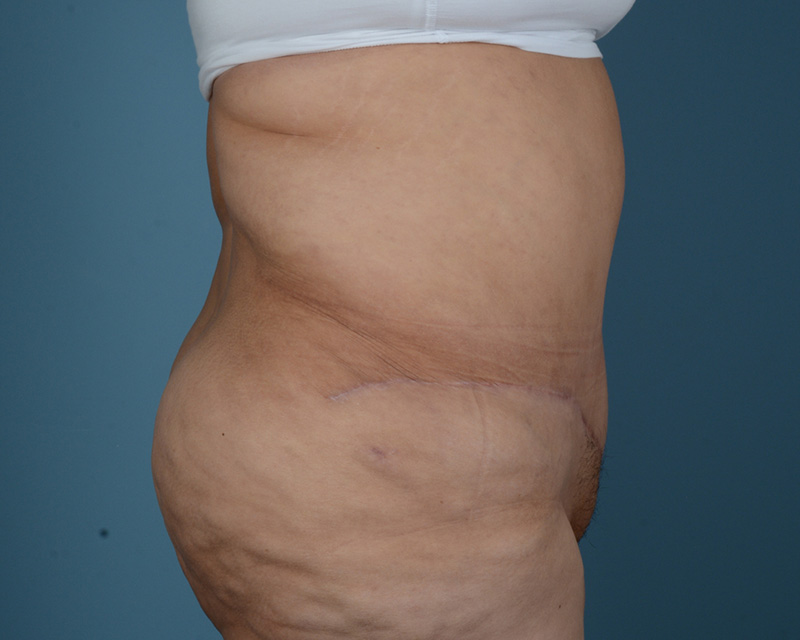 Surgery After Weight Loss Before and After | Dr. Thomas Hubbard