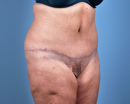 Tummy Tuck Before and After | Dr. Thomas Hubbard