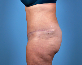 Tummy Tuck Before and After | Dr. Thomas Hubbard