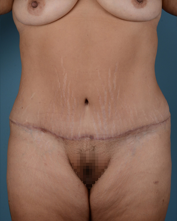 Tummy Tuck Before and After | Dr. Thomas Hubbard