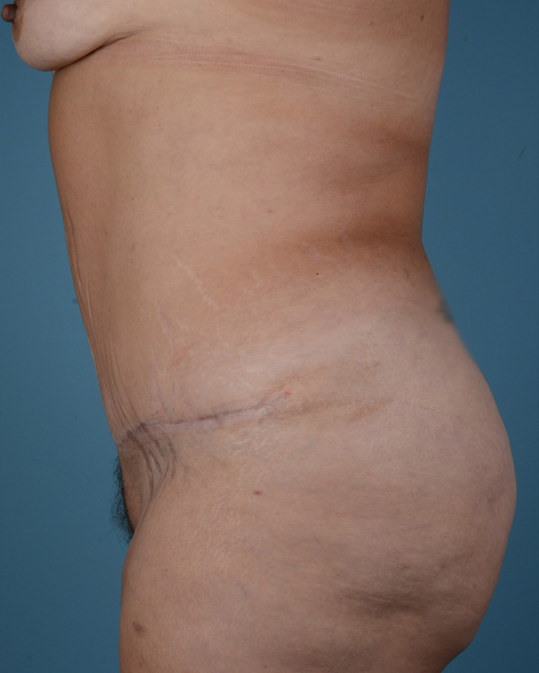 Tummy Tuck Before and After | Dr. Thomas Hubbard