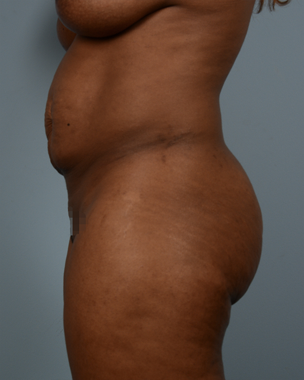 Before Abdominoplasty