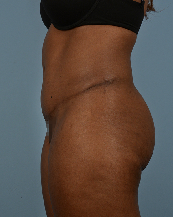 After Norfolk Va Abdominoplasty