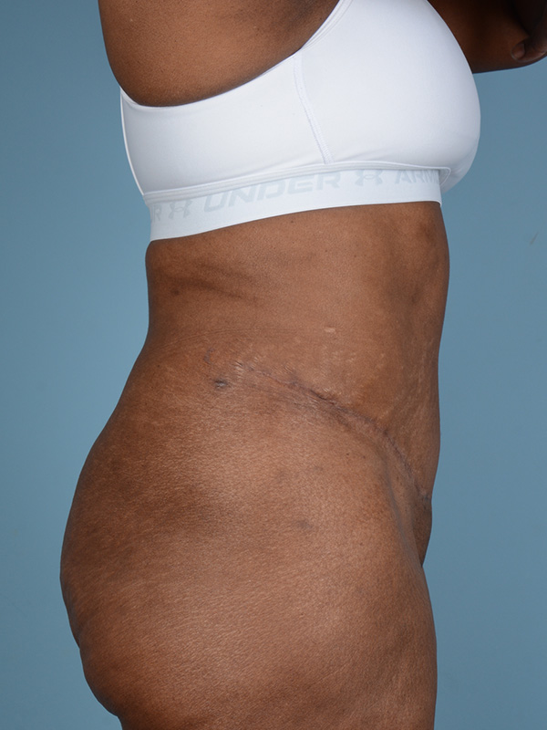 Tummy Tuck Before and After | Dr. Thomas Hubbard