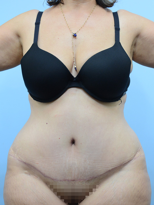 Tummy Tuck Before and After | Dr. Thomas Hubbard