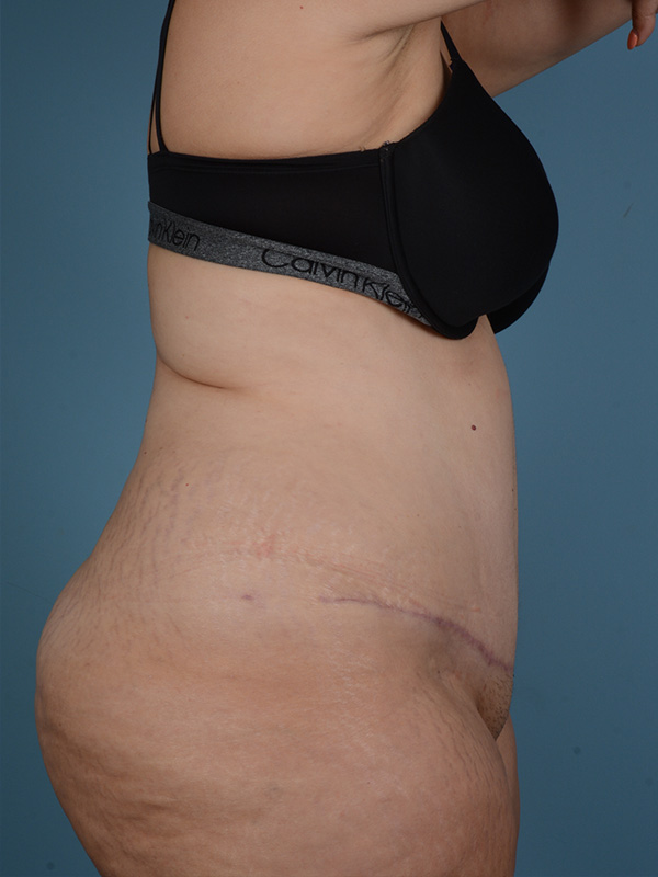 Tummy Tuck Before and After | Dr. Thomas Hubbard