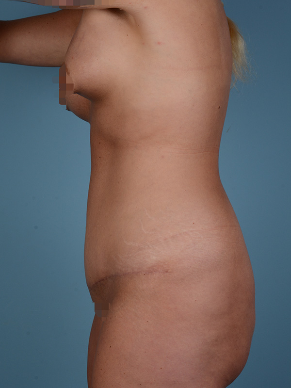 Tummy Tuck Before and After | Dr. Thomas Hubbard