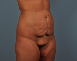 Tummy Tuck Before and After | Dr. Thomas Hubbard