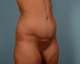 Tummy Tuck Before and After | Dr. Thomas Hubbard