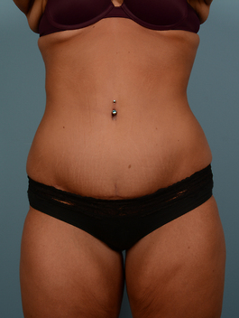 Tummy Tuck Before and After | Dr. Thomas Hubbard