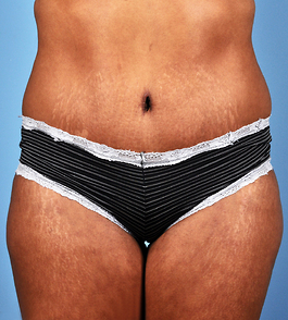 Tummy Tuck Before and After | Dr. Thomas Hubbard