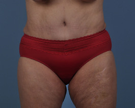 Tummy Tuck Before and After | Dr. Thomas Hubbard