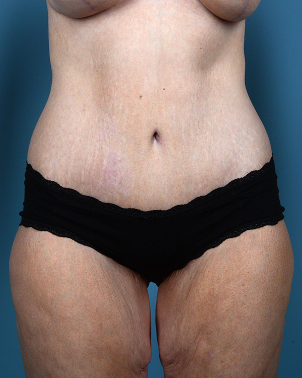 Tummy Tuck Before and After | Dr. Thomas Hubbard