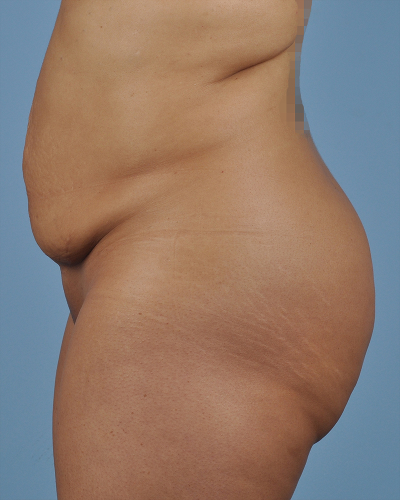 Tummy Tuck Before and After | Dr. Thomas Hubbard