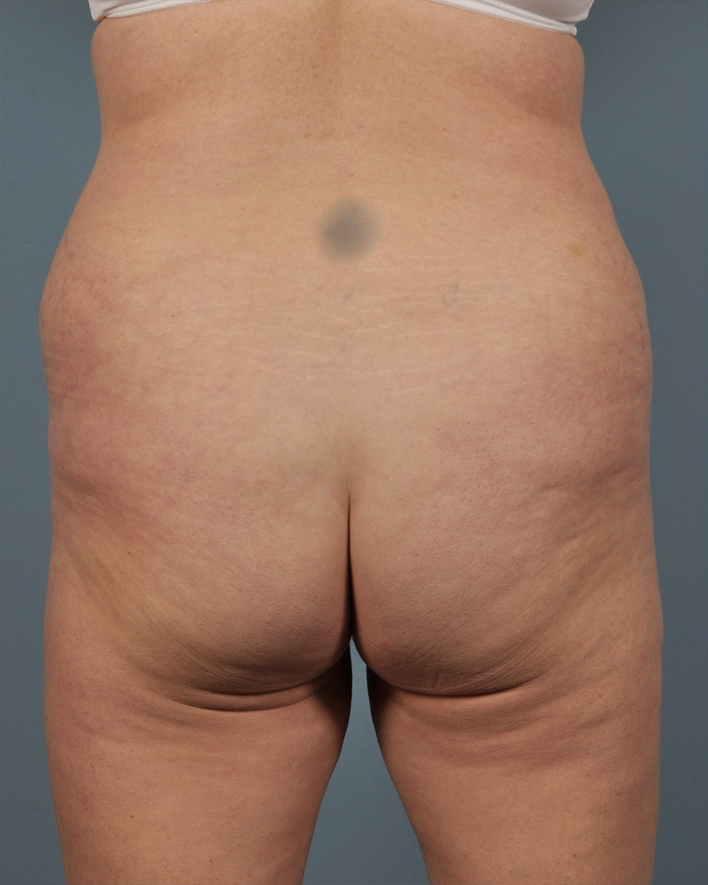 Tummy Tuck Before and After | Dr. Thomas Hubbard