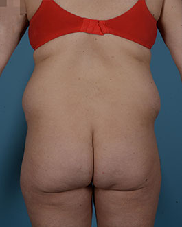 Tummy Tuck Before and After | Dr. Thomas Hubbard