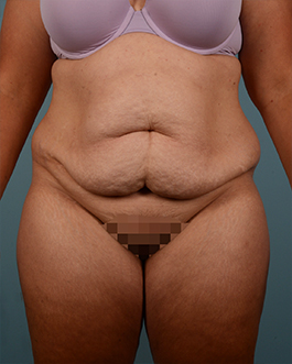 Tummy Tuck Before and After | Dr. Thomas Hubbard