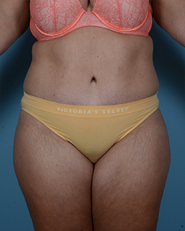 Tummy Tuck Before and After | Dr. Thomas Hubbard