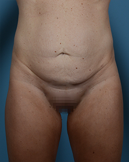 Tummy Tuck Before and After | Dr. Thomas Hubbard