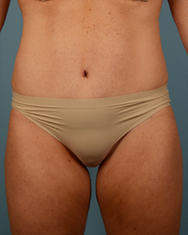 Tummy Tuck Before and After | Dr. Thomas Hubbard