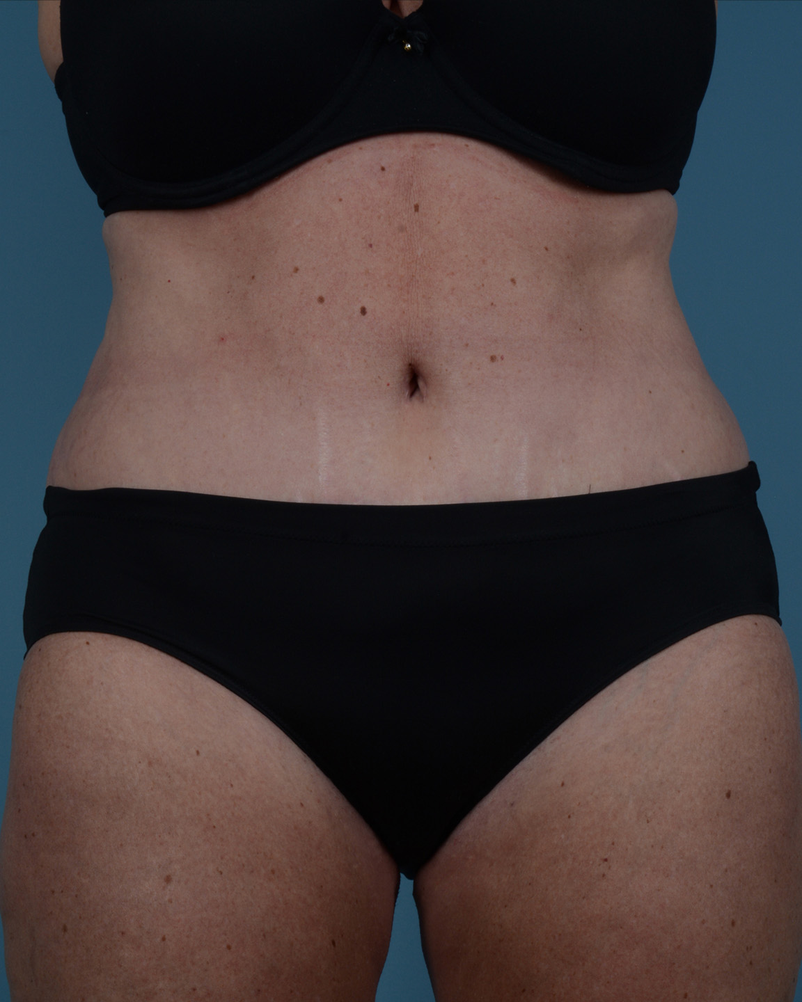 Tummy Tuck Before and After | Dr. Thomas Hubbard