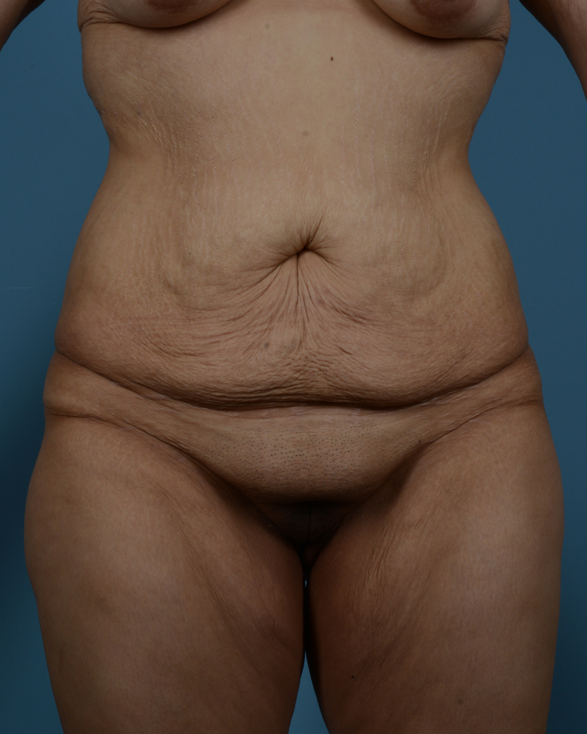 Tummy Tuck Before and After | Dr. Thomas Hubbard