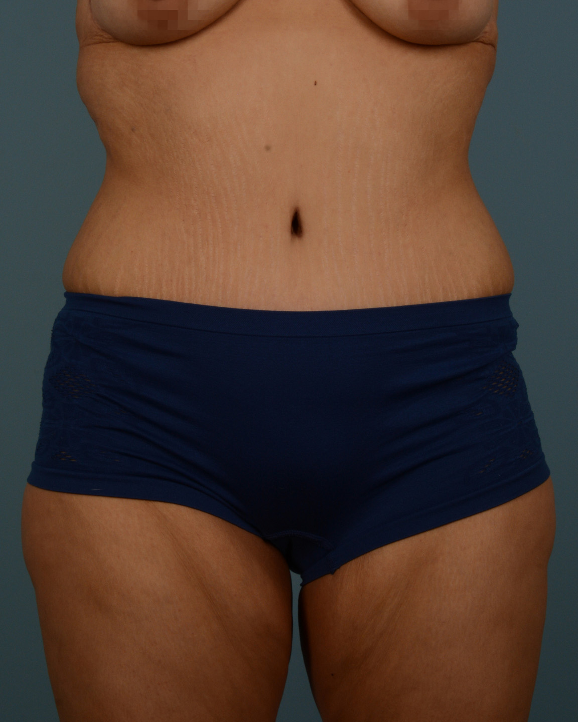 Tummy Tuck Before and After | Dr. Thomas Hubbard