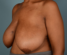 Breast Reduction Before and After | Dr. Thomas Hubbard