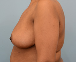 Breast Reduction Before and After | Dr. Thomas Hubbard