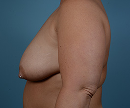 Breast Reduction Before and After | Dr. Thomas Hubbard