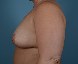 Breast Reduction Before and After | Dr. Thomas Hubbard