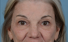 Brow Lift Before and After | Dr. Thomas Hubbard