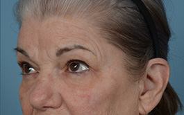 Brow Lift Before and After | Dr. Thomas Hubbard