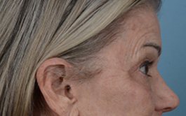 Brow Lift Before and After | Dr. Thomas Hubbard