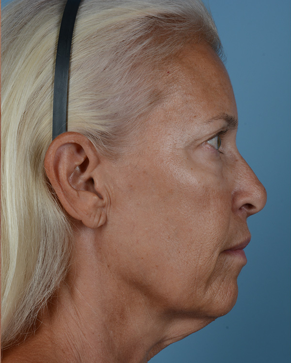 Face Lift Before and After | Dr. Thomas Hubbard