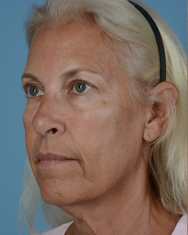 Face Lift Before and After | Dr. Thomas Hubbard