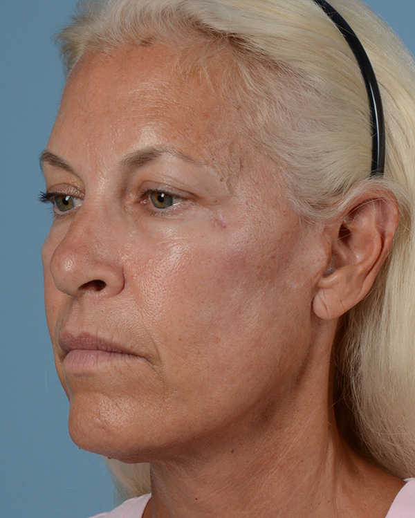 Face Lift Before and After | Dr. Thomas Hubbard